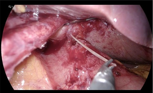 Fishbone extraction from the liver.