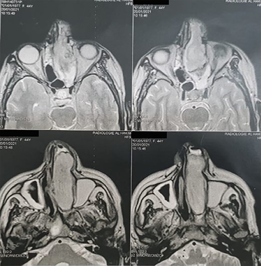 Head MRI showing a filling of the left nasal cavity by a neoplastic process.