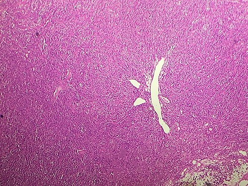 HE section showing diffuse fasciculated tumor (x10).
