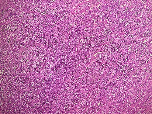 HE section showing diffuse fasciculated tumor (x20).