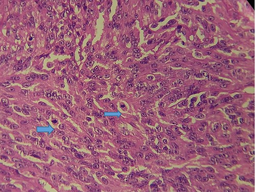 HE section showing tumor cells pleomorphisme and mitotic figures (blue arrow) (x40).