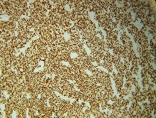 IHC: tumor cells express diffusely and intensely SOX10.