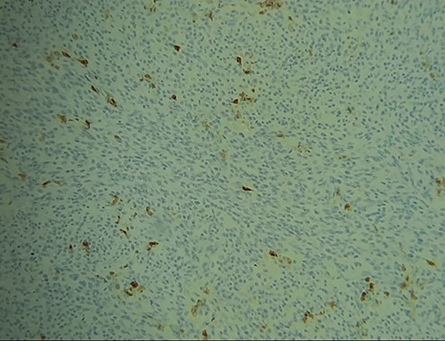 IHC: tumor cells express focally PS100.