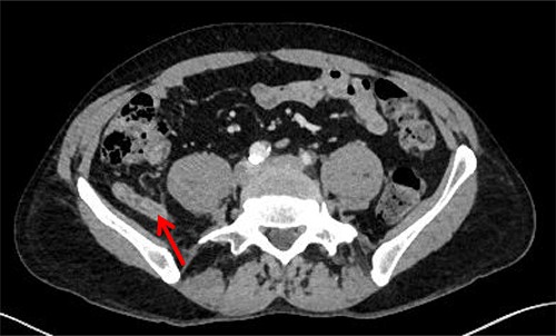 Axial CT image. Retro-psoas inflamed appendix (red arrow).