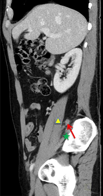 Sagittal CT image. Inflamed appendix (red arrow) positioned between psoas (yellow triangle) and iliacus muscles (green star).