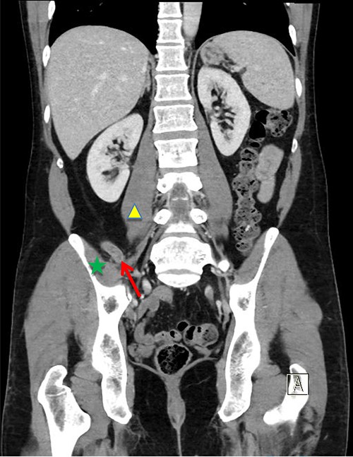 Coronal CT image. Inflamed appendix (red arrow) positioned between psoas (yellow triangle) and iliacus muscles (green star).