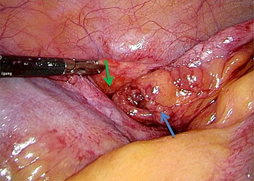 Laparoscopic image of inflamed appendix (blue arrow) herniated in retro-psoas muscle defect (green arrow).