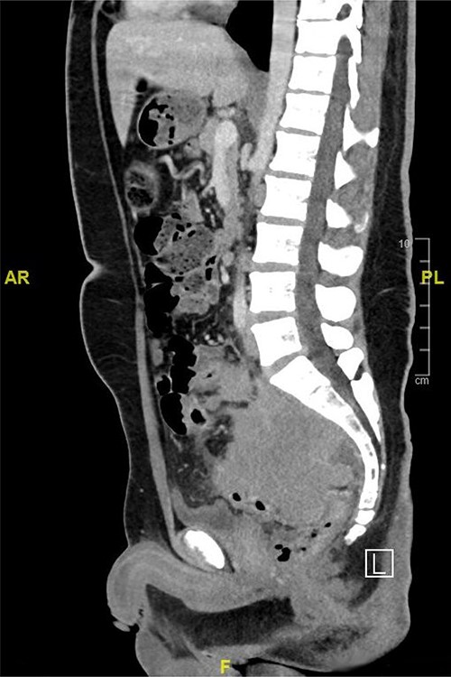 CT scan of the abdomen showed a large upper and mid-rectal mass.
