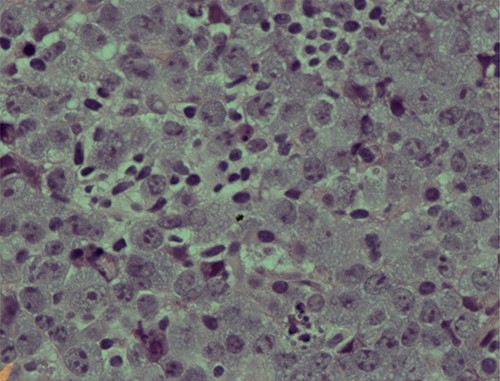 Photomicrograph showing an area of undifferentiated plasmablastic lymphoma; note the presence of large and pleomorphic tumor cells showing vesicular nuclei and conspicuous nucleoli with many apoptotic bodies: H/E stain X 600.