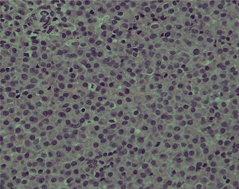 PBL; numerous neoplastic plasmacytoid cells with eccentric nuclei are seen; note the clear nuclear chromatin and conspicuous nucleoli in the majority of tumor cells: H/E stain X400B.