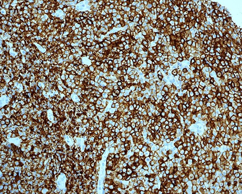 PBL; strong positive membranous staining with CD38 IHC stain X200.