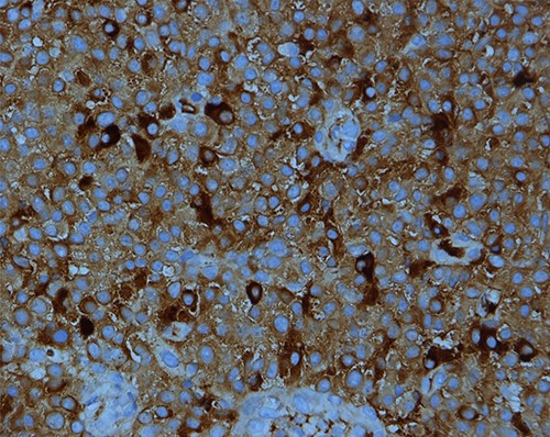 Kappa light chain restriction is obvious in this PBL; IHC stain for kappa light chain X400.