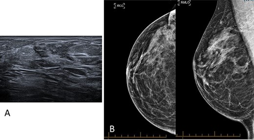 (A) Ultrasound imaging of the right breast highlighting increased density and a glandular ridge at 9 O’clock 6 cm from the nipple, BI-RADS classification score of 3. (B) Mammography imaging of the right breast demonstrating normal breast tissue.