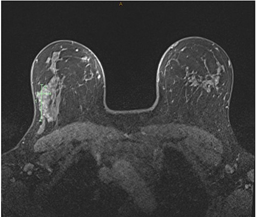 T1-weighted magnetic resonance images of the bilateral breast demonstrating asymmetric fibrocystic change and nodular glandular tissue with enhancement affecting tissue span of 15 mm × 45 mm × 28 mm on the right lateral breast without a focal lesion.