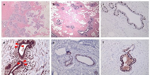 Histological slides and immunohistochemical characterization of gynaecomastia-like change in a female breast, with (a) showing the interface of the lesion with normal breast lobular tissue and (b) typical ducts of gynaecomastia present in the centre of the lesion. (c) p63 shows staining of only basal cells, (d) Bcl-2 staining accentuates an intermediate layer (arrows), which is also highlighted by ER staining (e), whereas CK5 staining is present in both the luminal and basal layers (f).