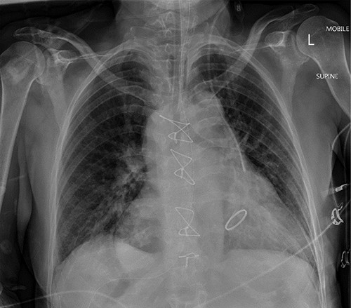 Mobile anteroposterior chest film. Demonstrates the nasogastric tube right of midline in stomach and the left internal jugular central line left of midline in the superior vena cava.