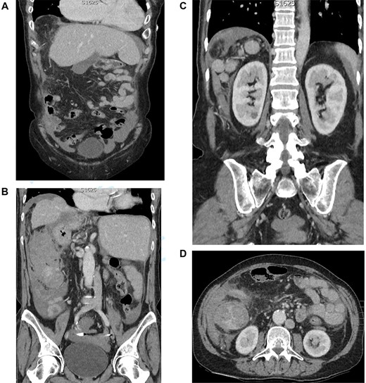 (A) CT coronal cross section demonstrating a left-sided liver and gallbladder. (B) CT coronal cross section demonstrating a right-sided stomach and abdominal aorta, left-sided inferior vena cava and the heterogenous lobulated mass with free fluid. (C) CT coronal cross section demonstrating the five splenunculi. (D) CT axial cross section demonstrating the 130 mm heterogenous lobulated mass in the right abdomen