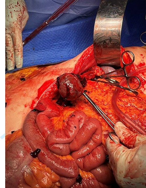 Intra-operative laparotomy showing accessory spleen before resection. Omentum has been dissected away and feeding vessels controlled.