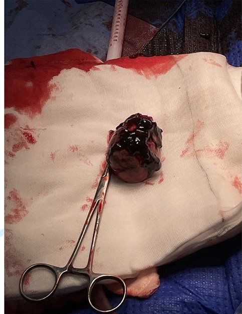 Accessory spleen post resection showing closely adhered clot.