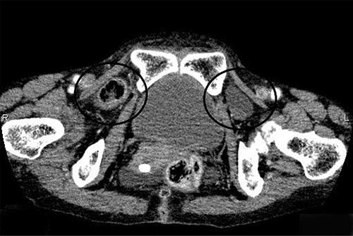 Abdominal CT scan revealed that the small bowel was incarcerated in the right obturator foramen and part of the bladder was impacted in the left obturator foramen.
