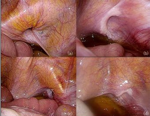 Laparoscopic view of the mesh placement; (a) right OH; (b) after repairing the right OH; (c) left OH; (d) after repairing the left OH.