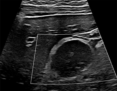 Initial abdominal US; abdominal US demonstrating hypoechoic, peri-pancreatic mass between stomach and pancreas (white box).
