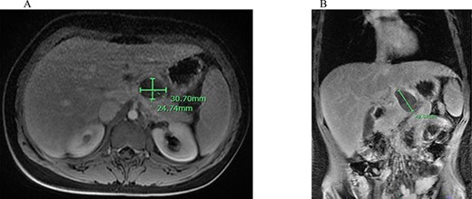 Abdominal MRI of suspicious mass; (A) axial abdominal MRI revealing 3.07 × 2.74 cm mass (green bars) posterior to the L. lobe of the liver and medial to the stomach; (B) coronal abdominal MRI demonstrating 4.26 cm mass (green bar) inferior to the liver and superior to the pancreas with peripancreatic inflammation.