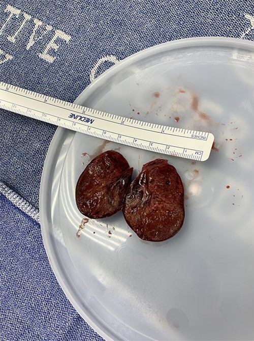 Ectopic liver mass; excised and bisected abdominal mass.