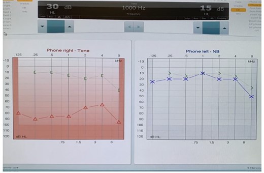 Preoperative image with the atretic temporal bone.