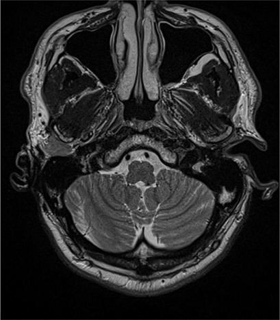 MRI showing atresia of the right external acoustic canal.
