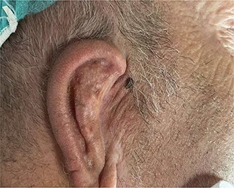 MRI atretic temporal bone right side.