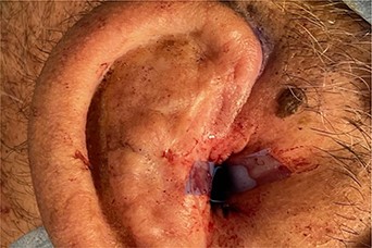 Surgical repair, formation of the new external canal.