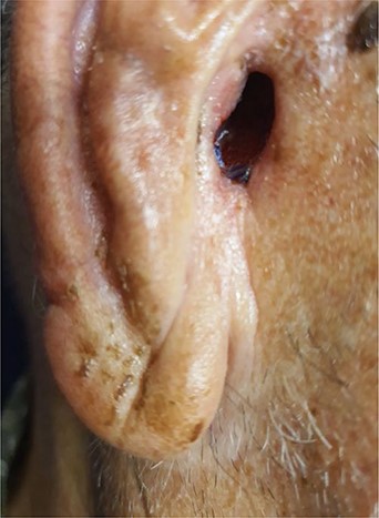 One month post-operation.