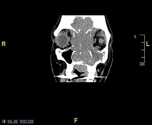 Coronal CT sinuses/head images displaying sinonasal mass invading anterior skull base, orbits and intracranially.