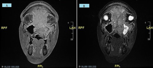 (A and B) Coronal MRI sinuses/head images displaying sinonasal mass invading anterior skull base, orbits and intracranially/intradurally (2A—T1 weighted, 2B—STIR).