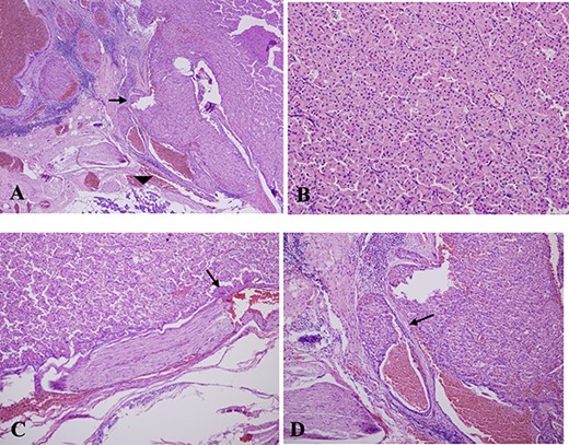 (A) Histologic features of the oncocytic mucoepidermoid carcinoma (arrow) with background normal salivary gland (arrowhead), low-power view. (B) High-power view. (C) Perineural invasion. (D) Vascular invasion. (hematoxylin and eosin-stained slide).