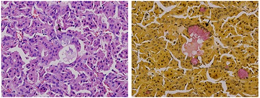 Mucicarmine stain shows the presence of mucous cells within nests of oncocytic cells. (A) Hematoxylin and eosin stained. (B) Mucicarmine stain.