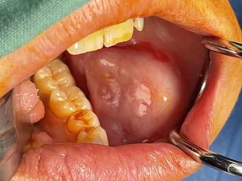 Intraoral appearance.