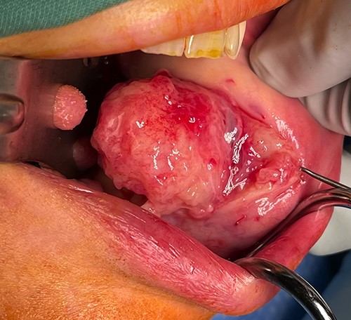 Appearance of lesion following buccal sulcus incision and dissection.
