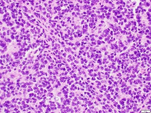 High-powered haematoxylin and eosin showing a uniform population of tumour cells with indistinct cell borders, irregular nuclei with fine dense chromatin and occasional mitotic figures.