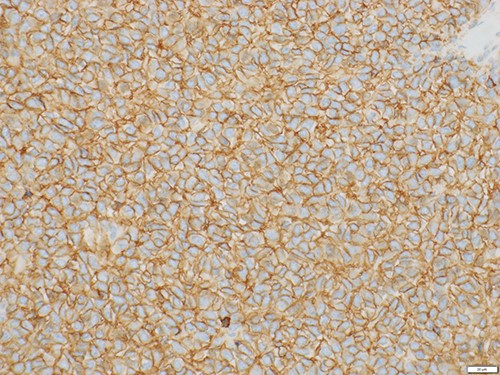 High-powered CD99 demonstrating strong diffuse membranous staining.