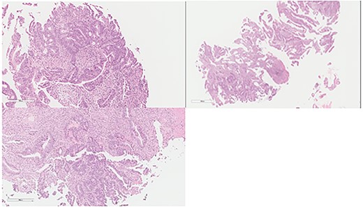 Colon: status of pre NAC: colonic mucosa with an infiltrative malignancy formed by tubules and gland of epithelial cells with high nucleus to cytoplasm ratio. The cells are large with frequent mitosis.