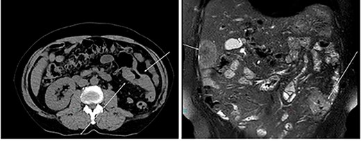 CT: status of pre administration of NAC.