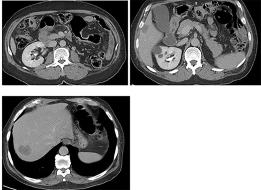 CT: status of post administration of NAC.