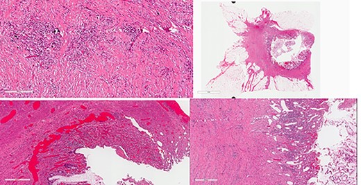Colon: status of post NAC with complete response. Mucosal ulcer, fibrosis, calcification and histolytic collection with no tumor cells.
