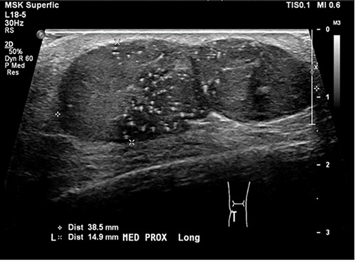 an ultrasound scan shows bilobed solid lesion measuring 39x15x24 mm.