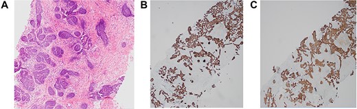 histopathology slides of a 35-year-old patient. (A) Haematoxylin and eosin (H&E) image. (B) p63 stain image. (C) CK5 stain image.