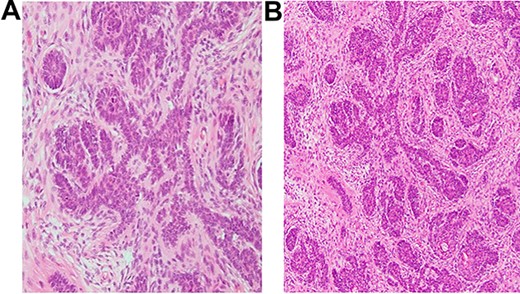 histopathology slides of a 35-year-old patient. (A and B) Dermal-based nodule with proliferating nests and cords of basaloid cells on a background of fibrotic stroma and presence of scattered mature folliculocystic structures.