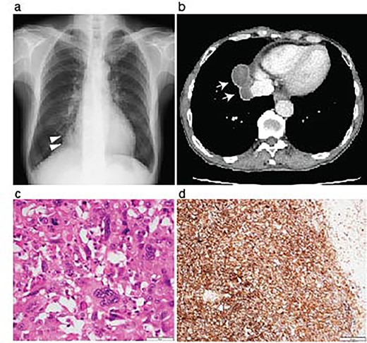 Resection of the lung pleomorphic carcinoma. A chest X-ray on admission showed a nodule in the right lung field (arrowheads) (a). Enhanced CT-scanning showed a well-circumvented nodule along the inferior vena cava (b, arrows). Hemotoxylin and eosin staining of the resected tumor showed the mixture of spindle and giant malignant cells consistent with the pleomorphic carcinoma (c). Immunohistochemistry revealed high PD-L1 expression with a tumor proportion score > 50%. Scale bar, 50 μm (c), and 200 μm (d).