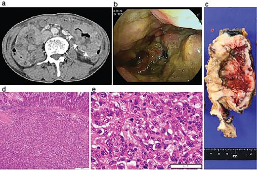 Identification of a metastatic intestinal tumor after lung surgery. An abdominal enhanced CT-scanning revealed a large mass lesion suggestive of small bowel involvement (a, arrows). A jejunum tumor was found in intestinal endoscopy (b). A surgical specimen of the metastatic lesion of the jejunum (c). H&E staining of the jejunum tumor showed submucosal malignant cells (d) with pleomorphic features compatible with the primary pleomorphic lung carcinoma (e).